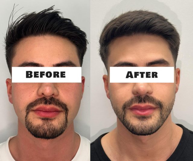 Lower Face Improvement with MPT HIFU!
Real results, no filters ✨
After just 2 sessions of MPT HIFU, our client achieved a visibly tighter, more defined jawline and lifted lower face, without surgery or downtime.
At HIFU 4 You Skin Lab, we specialise in advanced non-surgical facial tightening using MPT (Micro Pulsed Technology) HIFU, delivering powerful yet comfortable results that contour, lift, and rejuvenate your skin naturally.
Ready to redefine your jawline and feel more confident in your own skin?
📍 Booked appointments only.
We are located at 227 Collins Street, Melbourne CBD
📲 DM us or tap the link in bio to book your consultation today.
👇🏼
https://hifubeauty4you.com.au/contact/
.
.
.
.
.
.
#MPTLifting #HifuMelbourne #NonSurgicalLift #JawlineGoals #LowerFaceLift #SkinClinicMelbourne #CollinsStreetClinic #HIFUTreatment #SkinTightening #FacialLifting #MelbourneBeauty #MensSkincare #BeforeAndAfter #RealResults #SkincareExperts #HifuForMen #ConfidenceStartsHere