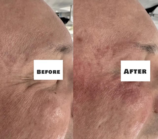 Straight away after the second session of our Eye Rejuvenation Protocol using MPT (Micro Pulsed Technology) for narrow areas.

MPT HIFU is an advanced ultrasound technology that delivers precise, controlled energy to the superficial muscular aponeurotic system (SMAS) and dermal layers. By using micro pulses, it enhances tissue stimulation while minimizing discomfort, making it ideal for delicate areas like the periocular region.

This process promotes neocollagenesis and improves skin elasticity, helping to visibly soften fine lines and wrinkles around the eyes, while achieving a natural lifting effect.

Mild erythema may be present immediately post treatment, however, this typically resolves within 24 to 72 hours.

Book your treatment today and experience clinically driven results.

HIFU 4 You Skin Lab

Send us a email!👇🏼💌

Info@hifubeauty4you.com.au 

#EyeRejuvenation #HiFuTreatment #SkinTightening #AntiAgingSkin #MelbourneSkinClinic