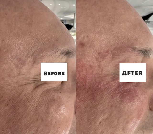 Straight away after the second session of our Eye Rejuvenation Protocol using MPT (Micro Pulsed Technology) for narrow areas.
MPT HIFU is an advanced ultrasound technology that delivers precise, controlled energy to the superficial muscular aponeurotic system (SMAS) and dermal layers. By using micro pulses, it enhances tissue stimulation while minimizing discomfort, making it ideal for delicate areas like the periocular region.
This process promotes neocollagenesis and improves skin elasticity, helping to visibly soften fine lines and wrinkles around the eyes, while achieving a natural lifting effect.
Mild erythema may be present immediately post treatment, however, this typically resolves within 24 to 72 hours.
Book your treatment today and experience clinically driven results.
HIFU 4 You Skin Lab
Send us a email!ππΌπ
Info@hifubeauty4you.com.au
#EyeRejuvenation #HiFuTreatment #SkinTightening #AntiAgingSkin #MelbourneSkinClinic