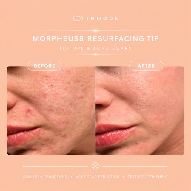 MORPHEUS8 RESURFACING TIP - ADVANCED ACNE SCAR & TEXTURE CORRECTION
Acne scars, enlarged pores, and uneven skin texture are often the result of chronic inflammation and collagen disruption within the skin. The Morpheus8 Resurfacing Tip is specifically designed to target the superficial dermal layers where many textural concerns originate. By combining fractional radiofrequency (RF) energy with advanced resurfacing technology, it stimulates neocollagenesis and elastin production while promoting epidermal renewal.
Benefits of Morpheus8 Resurfacing Tip include:
✔ Improvement of acne scars and post-inflammatory skin irregularities
✔ Refinement of skin texture and smoother skin surface
✔ Reduction in enlarged pores
✔ Enhanced collagen remodeling and dermal regeneration
✔ Improvement in skin tone uniformity
✔ Softening of superficial textural imperfections
✔ Increased skin firmness and overall skin quality
✔ Minimal downtime compared to more aggressive resurfacing procedures
This treatment is ideal for patients seeking a clinically advanced solution for acne scarring, rough texture, enlarged pores, and overall skin rejuvenation without the extended recovery associated with traditional ablative treatments.
🧬Clinical study image. Individual results may vary.
📍 Book your consultation today and discover whether Morpheus8 Resurfacing Tip is the right treatment for your skin concerns.
📩 DM us to learn more or secure your appointment.
#Morpheus8 #AcneScars #SkinResurfacing #TextureCorrection #MelbourneSkinClinic